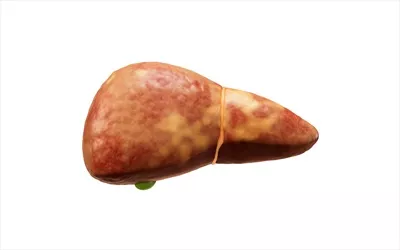 عکس مدل سه بعدی کبد با وضعیت چربی کبدی برای بررسی پزشکی