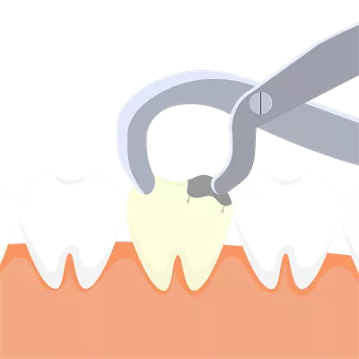 عکس دوربری استخراج دندان مرده توسط دندانپزشک با استفاده از تجهیزات تخصصی