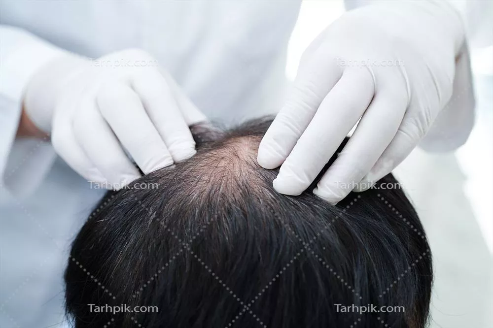 عکس درمان ریزش مو در مردان: راهکارهای پزشکی و تاثیرات آن بر سلامت