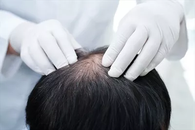 عکس درمان ریزش مو در مردان: راهکارهای پزشکی و تاثیرات آن بر سلامت