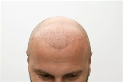 عکس مردی که پس از درمان کاشت مو به زندگی جدیدی دست یافته است