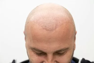 عکس مردی که پس از درمان کاشت مو به زندگی جدیدی دست یافته است
