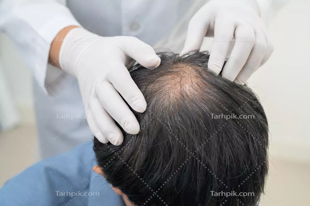 عکس بررسی و درمان مشکلات ریزش مو در مردان آسیایی با کچلی