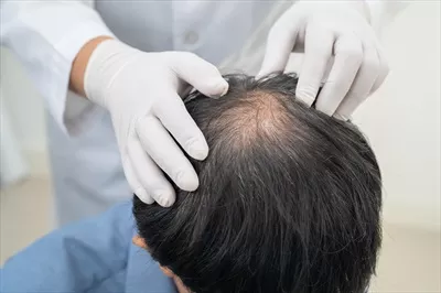 عکس بررسی و درمان مشکلات ریزش مو در مردان آسیایی با کچلی
