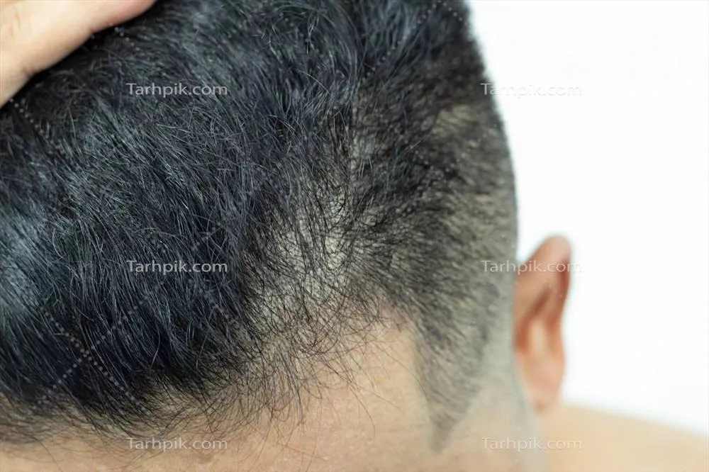 عکس مشکلات رایج جوانان در زمینه مو: ریزش، خشکی و آسیب های مختلف