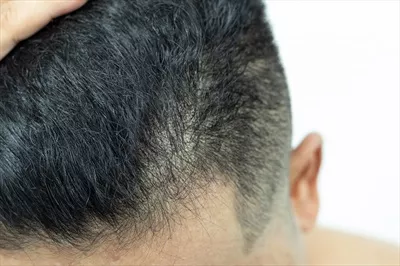 عکس مشکلات رایج جوانان در زمینه مو: ریزش، خشکی و آسیب های مختلف