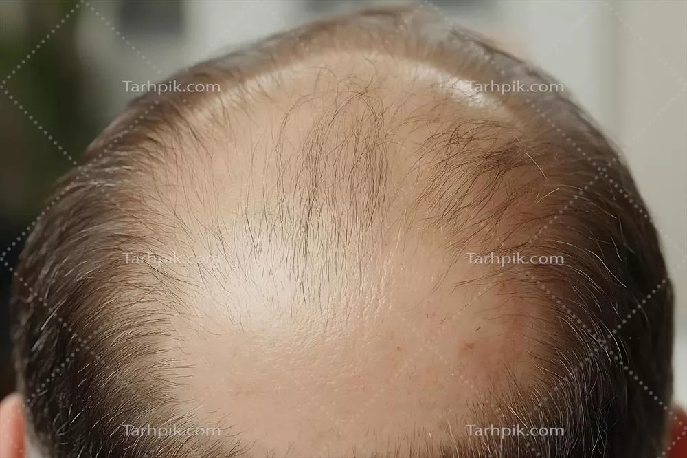 عکس تصویری نزدیک از موهای نازک و پوست سر با نشانه های اولیه طاسی