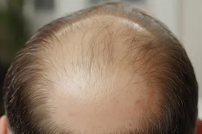 عکس تصویری نزدیک از موهای نازک و پوست سر با نشانه های اولیه طاسی