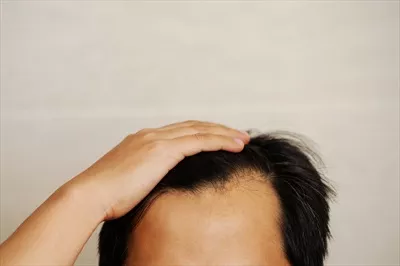 عکس تأثیر استرس بر روی ریزش مو و سفیدی مو در مردان