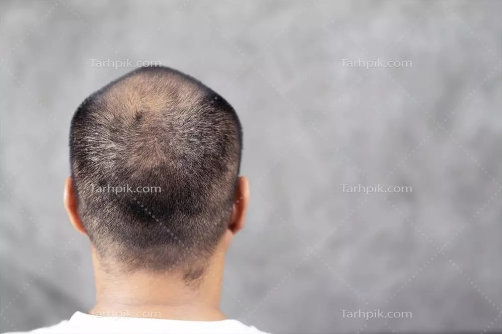 عکس مردی با مشکلات مو: داستانی از طاسی و اعتماد به نفس