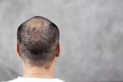 عکس مردی با مشکلات مو: داستانی از طاسی و اعتماد به نفس