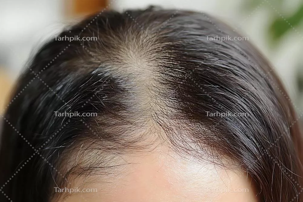 عکس تصویری نزدیک از پوست سر یک فرد با موهای تیره و نازک شده