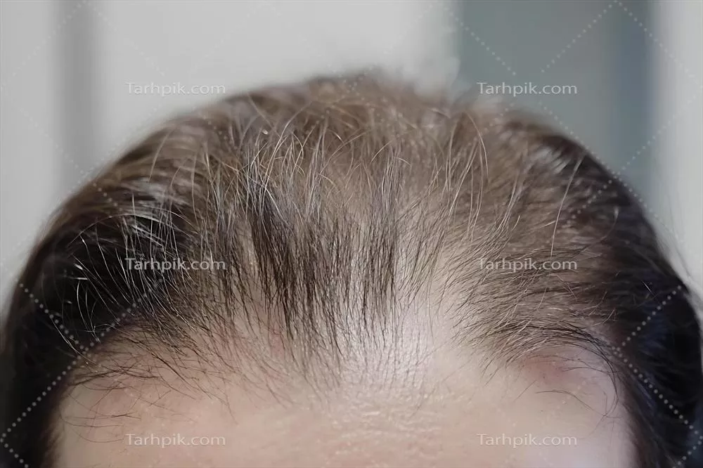 عکس تصویری نزدیک از ریزش مو و خط موی عقب رفته در افراد