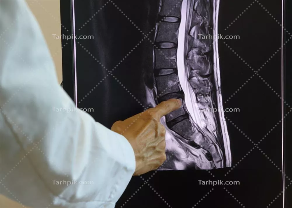 عکس پزشک در حال نشان دادن تصویر MRI از ستون فقرات کمری