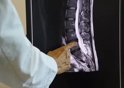 عکس پزشک در حال نشان دادن تصویر MRI از ستون فقرات کمری