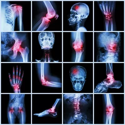عکس مجموعه ای از تصاویر مفاصل انسانی و بیماری های آرتروز و سکته مغزی