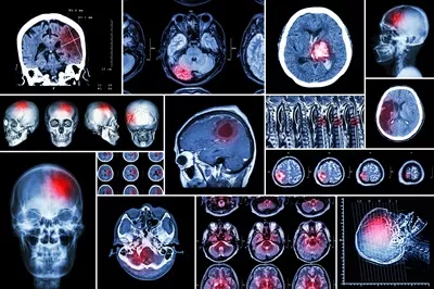 عکس مجموعه ای جامع از بیماری های مغزی و توصیف آن ها