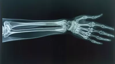 عکس تصویری دقیق از استخوان های ساعد انسان شامل شعاع و اولنا برای تحلیل پزشکی