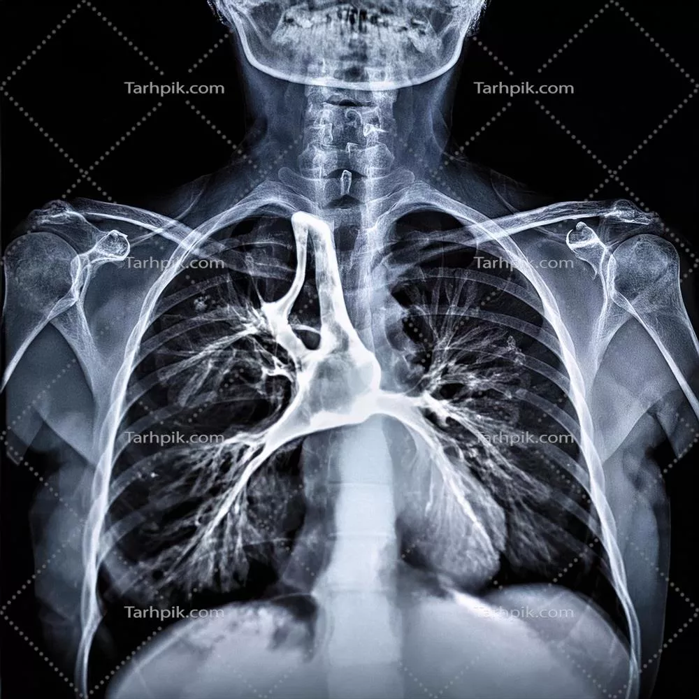 عکس تصویری دقیق از سی تی اسکن قفسه سینه با جزئیات کامل