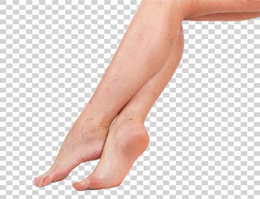 پاهای زن با پوست و نخلهای واریسی: زیبایی و عوارض