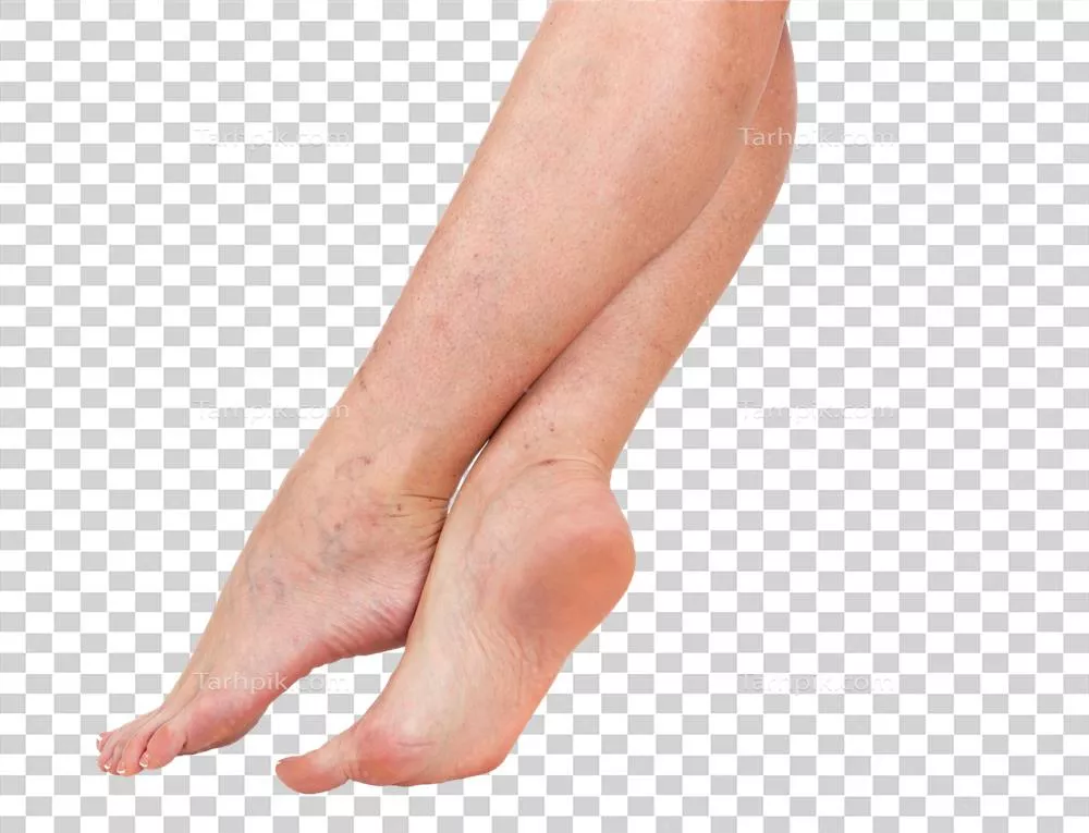 پوست پاهای زنانه با ستاره‌های عروقی زیبا و جذاب